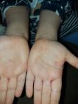 Красная сыпь на руках ребенка после орви без зуда, боли фото 2
