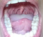 Боль в горле возде правой мендалины фото 1