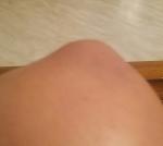 Шишка на внешней стороне колена фото 2