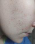 Непроходящие Красные точки на лице, покраснение кожи в области щек фото 3