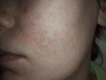 Непроходящие Красные точки на лице, покраснение кожи в области щек фото 2