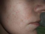 Непроходящие Красные точки на лице, покраснение кожи в области щек фото 1