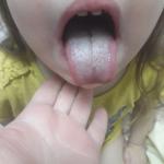 Белый налет на языке у ребёнка фото 1