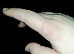 Долгое время зудит палец на руке, кожа грубеет и трескается фото 2
