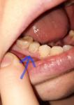 Кровит десна, зубные камни, штифт, зуб фото 2