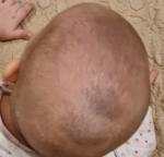 Серо-синие пятна на голове ребёнка фото 1
