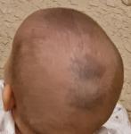 Серо-синие пятна на голове ребёнка фото 2