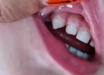 Белые пятна на зубах фото 2