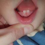 Белые полоски и точки на зубах у ребенка фото 2