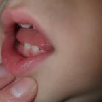 Белые полоски и точки на зубах у ребенка фото 1
