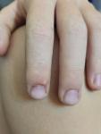 Сыпь на пальце у ребенка болит фото 2
