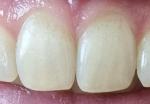 Странные пористые углубления на передних зубах фото 1