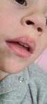 Красная кайма на верхней губе у ребёнка 2.10 фото 3