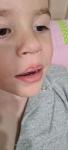 Красная кайма на верхней губе у ребёнка 2.10 фото 1