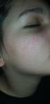 Сыпь на лице у подростка фото 2
