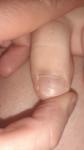 Чёрная точка под ногтем у ребёнка фото 2