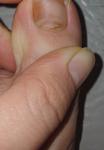 Коричневое пятно на ногте, опасно ли? фото 2