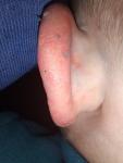 Червоні цятки що переходять у ранки на вухові дитини фото 3