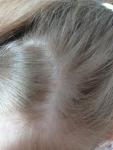 Розовое пятно на голове у 10 летнего ребёнка фото 2