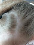 Розовое пятно на голове у 10 летнего ребёнка фото 1