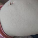 Сыпь на теле ребёнка с аллергией на молоко фото 2