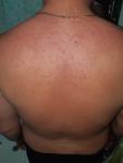 Аллергия на спине фото 1