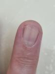 Темная полоска на ногте фото 3