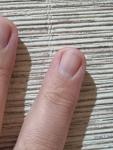 Темная полоска на ногте фото 1