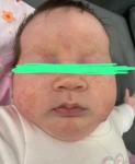 Аллергия, акне, новорожденный фото 1