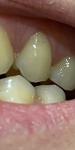 Боль в пришеичной области зуба фото 2