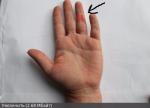Хирург надрезал палец фото 1