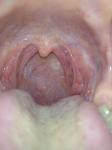 Боль в горле, гиперемия, субфебрильная температура фото 2