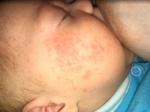Аллергия и акне у месячного ребёнка фото 3