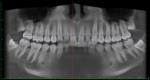 Хроническая боль в районе зубов, боль напряжения в висках фото 1