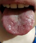 Воспаление горла, образование наростов на горле и языке фото 2