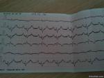 Помогите, пожалуйста, расшифровать кардиограмму и подтвердить диагноз фото 1