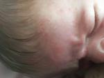 Аллергия ли у ребёнка или потница? фото 3