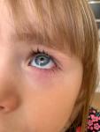 Воспаление глаза у ребёнка 4 лет фото 5