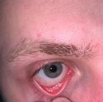 Белые точки на слезном мясце, возможно опухлость и краснота глаза фото 3