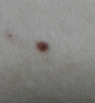 Brown dot appeared on my breast фото 1