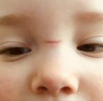 Профилактика шрама у ребёнка фото 2