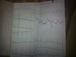 Расшифровка кардиограммы, ноющие боли в сердце фото 1