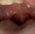 Язва во рту + горло болит 2 недели фото 2
