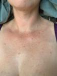 Аллергия Дерматит после чесотки фото 1