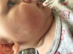 Высыпания на щеках у ребенка фото 3