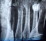 Перелом пятой плюсневой кости левой стопы фото 2
