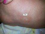 Гемангиома на спине у ребенка 3 месяца фото 2