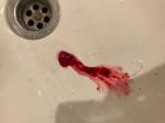 Обильная красно-бурая кровь при кашле фото 1