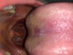 Розовые пятнышки во рту фото 2