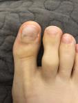 Темные пятна на пальцах ног фото 2